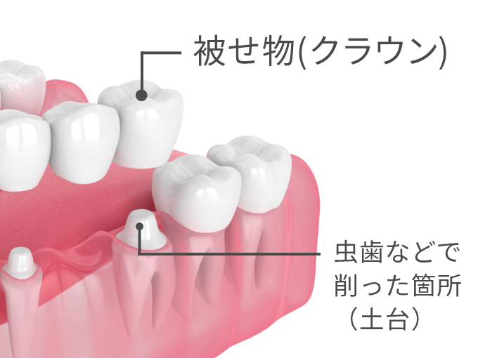 被せ物とは