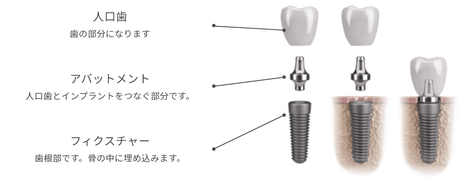 人口歯 歯の部分になります アバットメント 人口歯とインプラントをつなぐ部分です。 フィクスチャー 歯根部です。骨の中に埋め込みます。