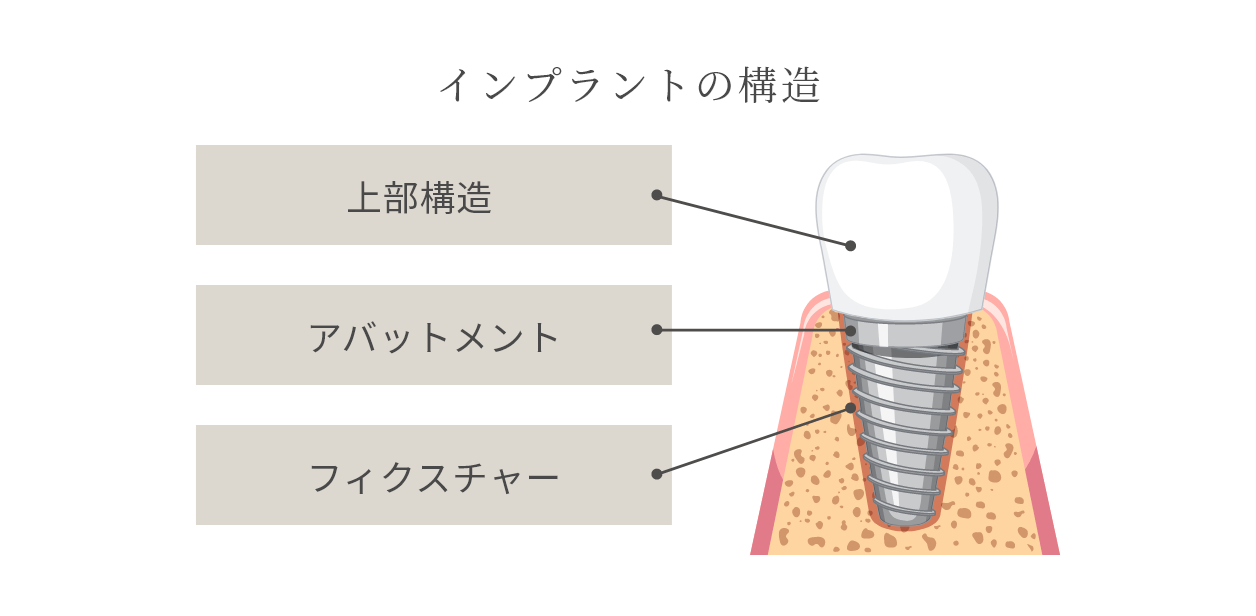インプラントの構造 上部構造 アバットメント フィクスチャー