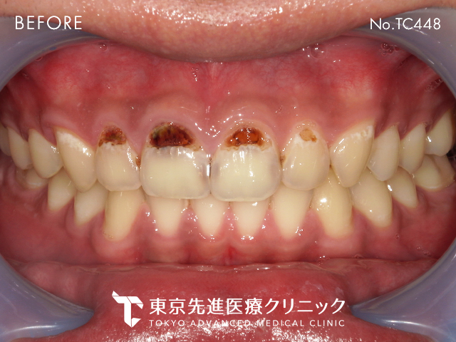ジルコニアセラミック BEFORE