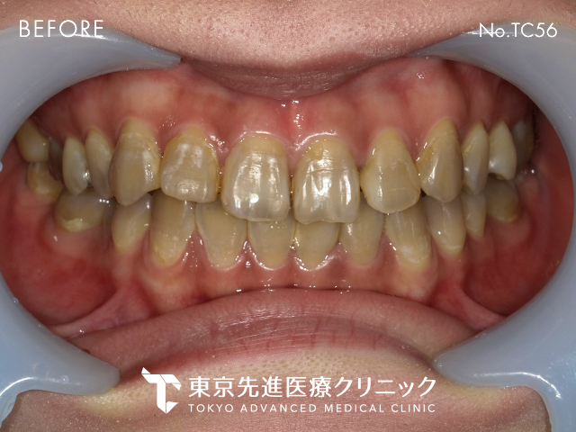 セラミッククラウン BEFORE/AFTER 1